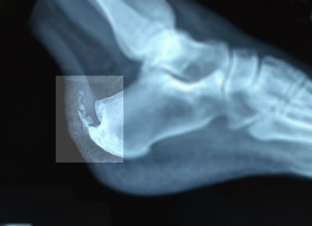 Bone Spur Heel X Ray