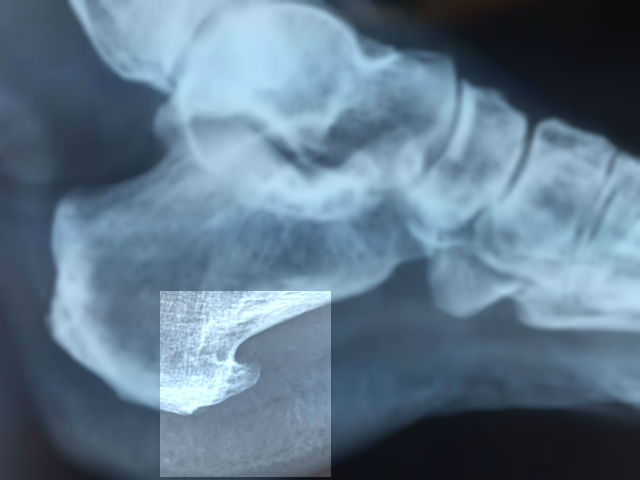 Calcaneal Spur